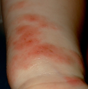 I Hate Eczema